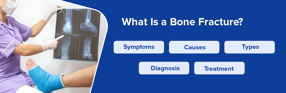 What Is A Bone Fracture? Know Its Symptoms, Causes, Types, Diagnosis And Treatment